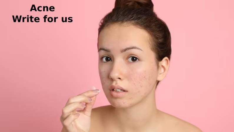 Acne Write for us