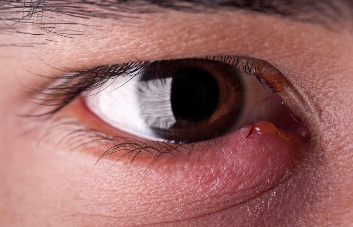 Pesky Stye Write for Us