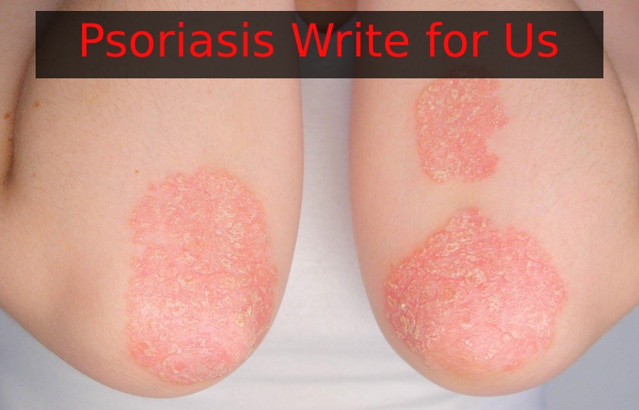Psoriasis Write for Us