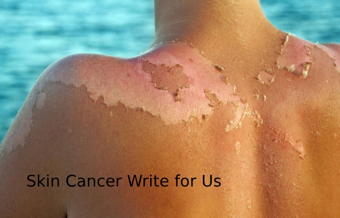 Skin Cancer Write for Us