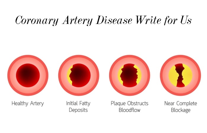 Coronary Artery Disease Write for Us