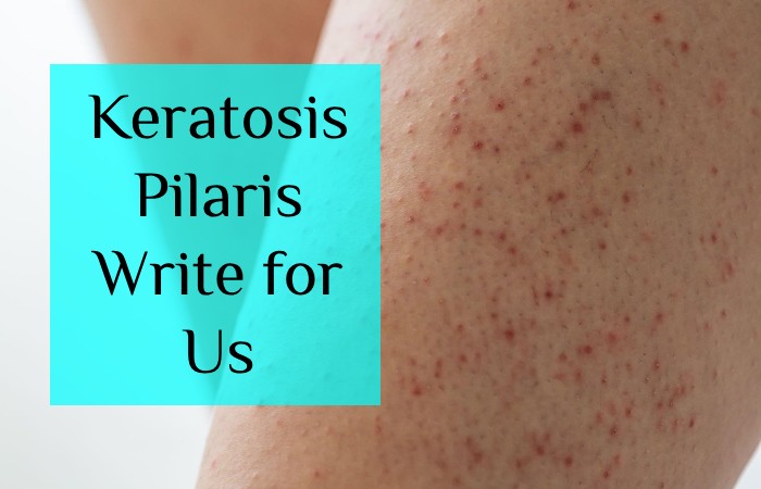 Keratosis Pilaris Write for Us