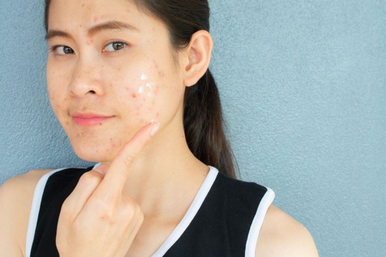 4 Hair Removal Tips for Melasma-Prone Individuals