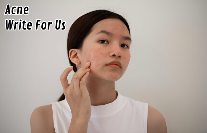 Acne Write For Us