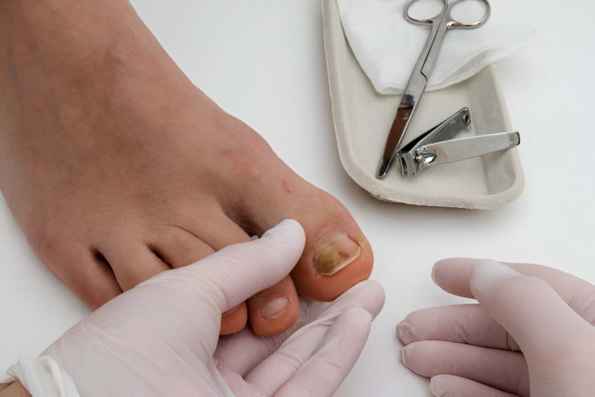 Onychomycosis (Nail Fungal) Write for Us - Guest Post, Contribute, and Submit Post