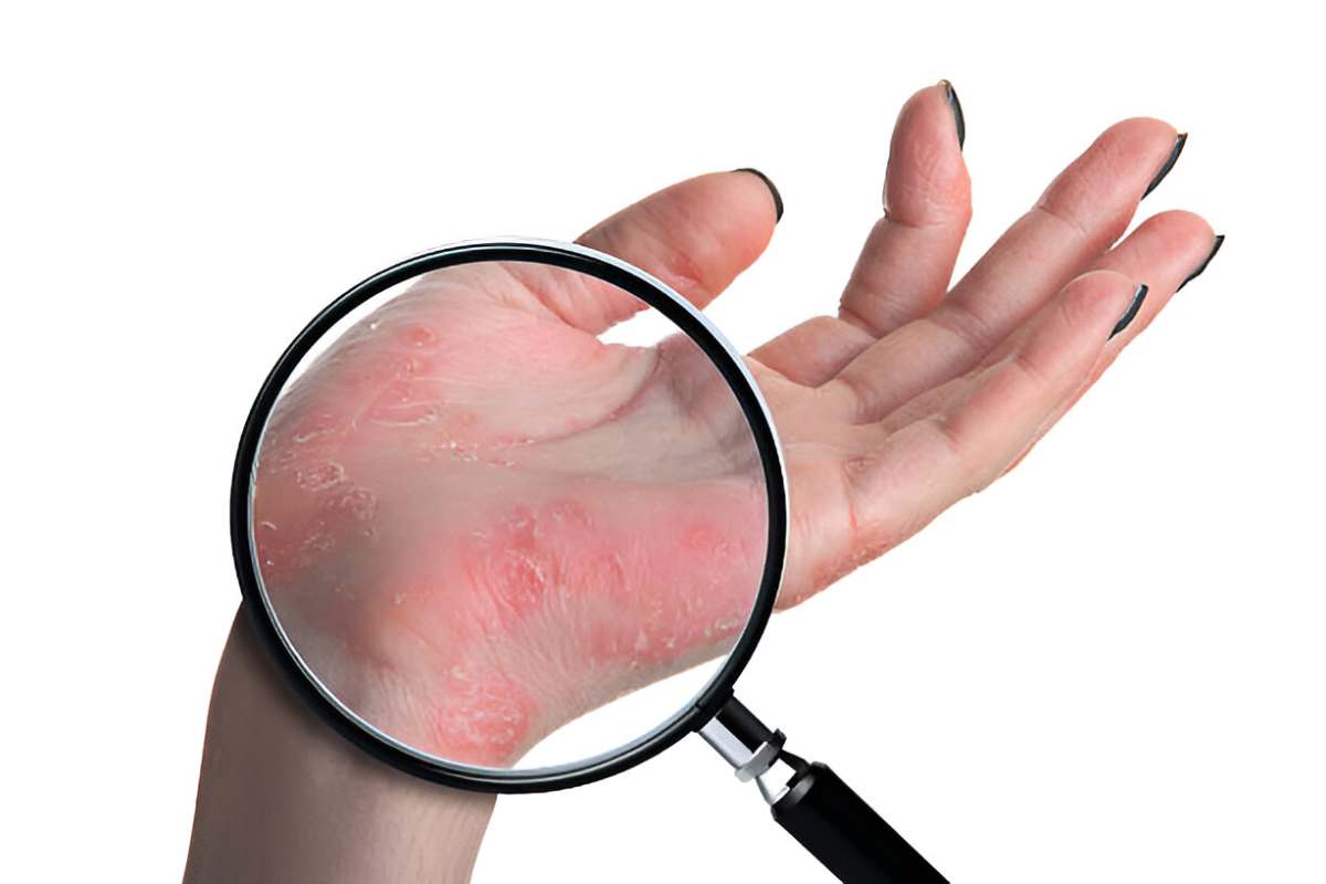 Psoriasis Write for Us - Guest Post, Contribute, and Submit Post