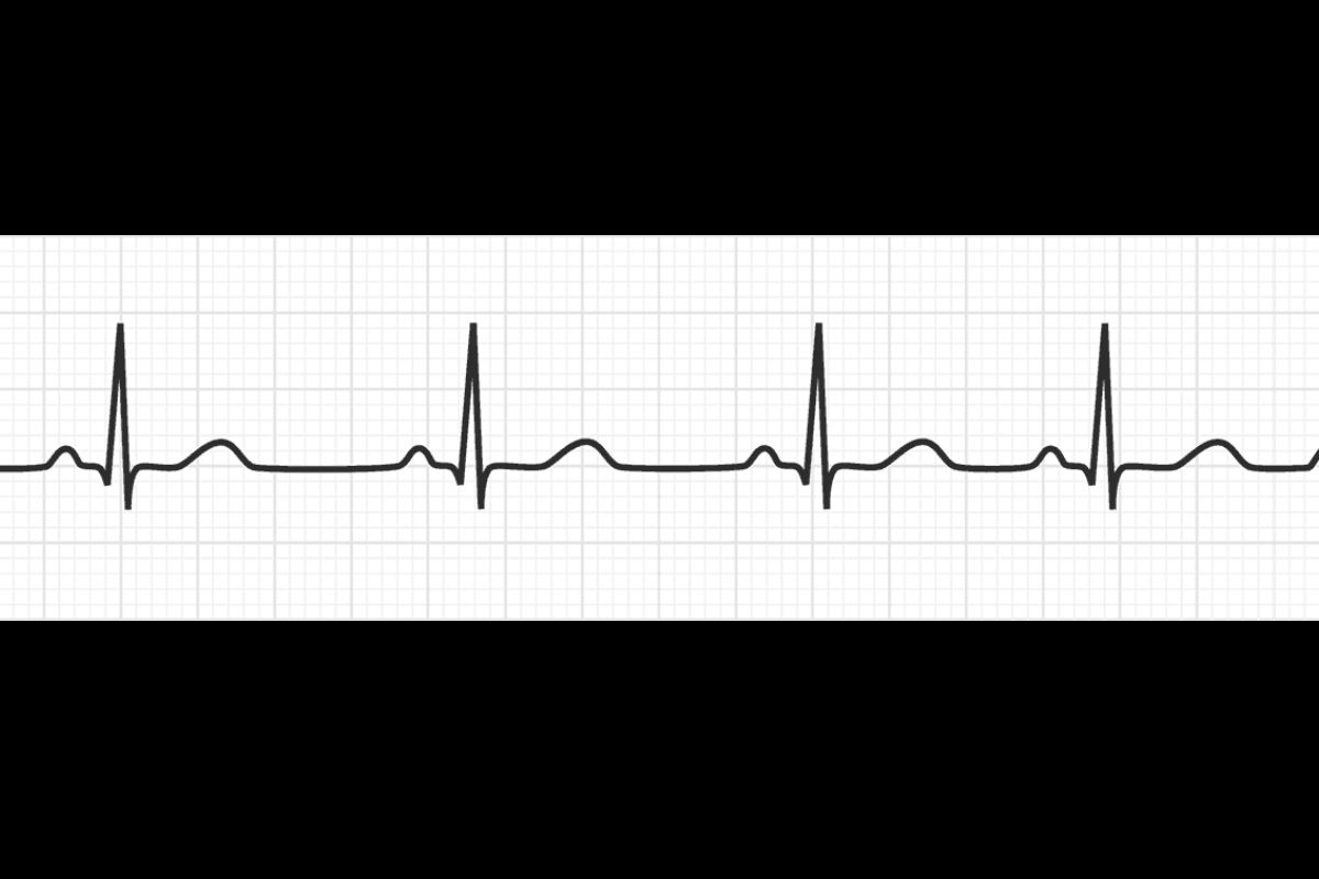 Sinus Rhythm Guest Post | Submit Heart Health & Cardiology Articles